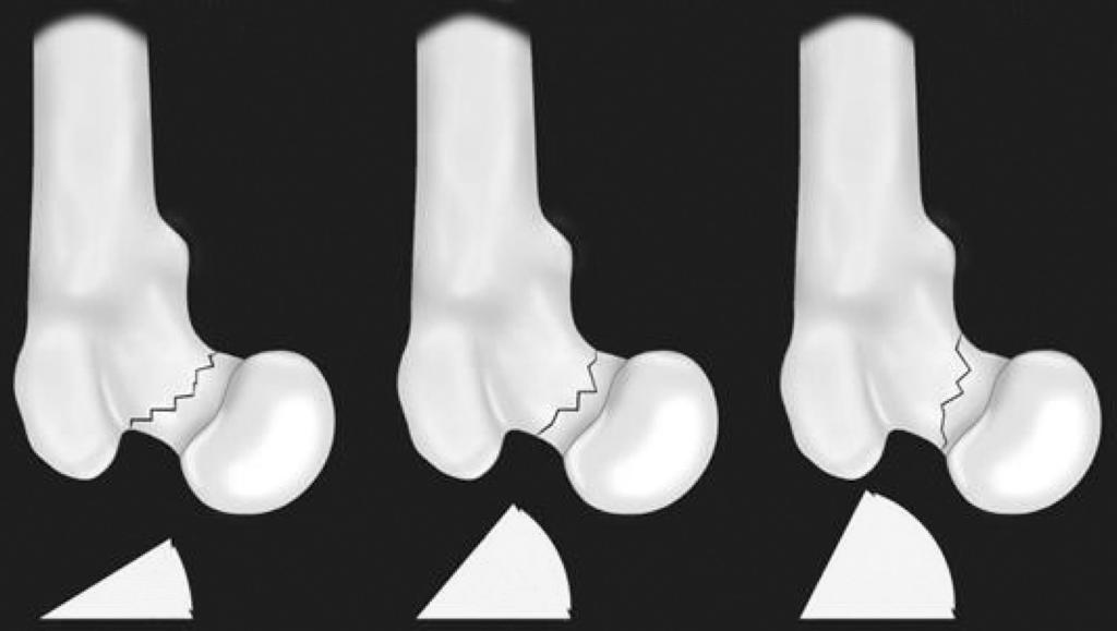 180 Ingwon Yeo and Seung-Jae Lim <30 30 50 >50 Type I Type II Type III Figure 4. The Pauwels classification of femoral neck fracture based on vertical orientation of fracture line.