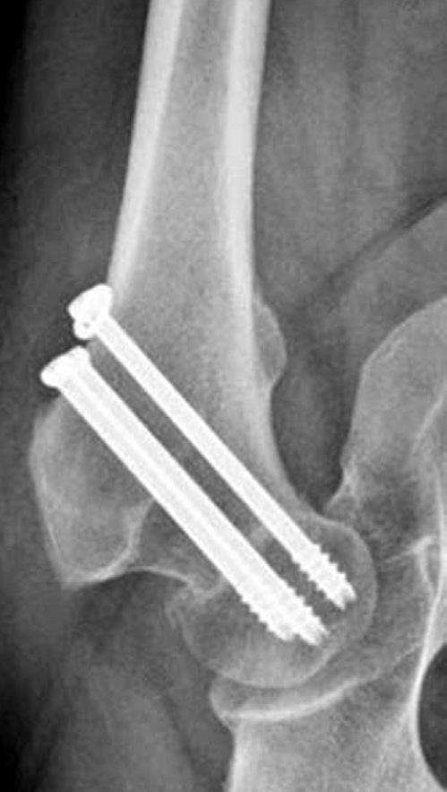 183 Young Adult Femur Neck Fractures 방법은내고정물삽입시에별개의절개가필요하다는단점이있다.