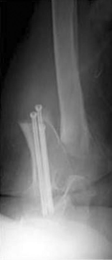 A displaced femoral neck fracture was reduced and fixed with three cannulated screws in a reverse triangle configuration on