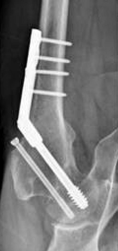 55,56) 한편근위대퇴잠김금속판 (proximal femoral locking plate) 은골절부의압박을허용하지않는고정물고유의특성과고정전에적절한해부학적정복과골절부의압박이선행되어야하는문제점이지적되어왔으나 57) Boraiah 등 58) 이수술중골절부위를압박후길이안정적인 (length-stable) 고정을하는방법을소개하였고, Della Rocca 59)