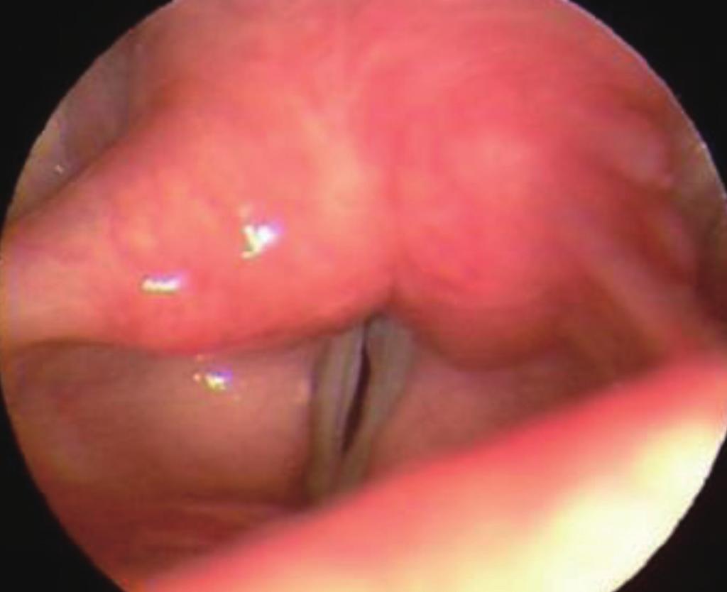 Telescopy shows a groove at the free edges of the bilateral true vocal folds suspicious for sulcus vocalis.