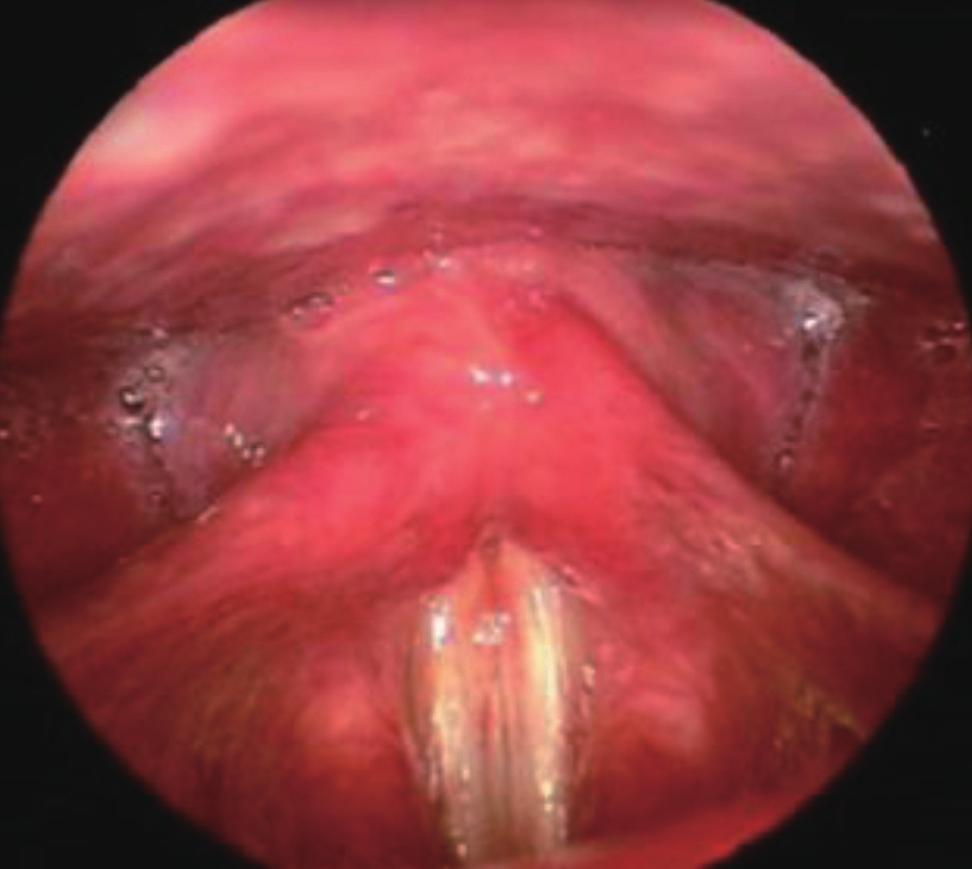 No other abnormality was noted in larynx (arrows: main sulcus vocalis lesion on both vocal folds). Fig. 4. Case 2.