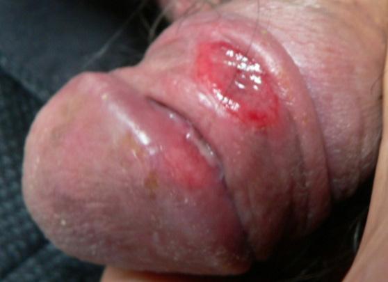 KOREAN STI GUIDELINES 2016 매독 (Syphilis) 병인 Treponema pallidum 병기임상소견임상사진 1 기 잠복기 : 3 주 (3~90 일