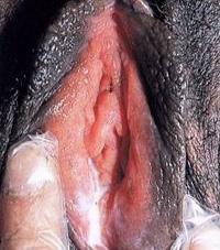 성매개감염진료지침 임균감염증 (Gonococcal Infections), 임질 (Gonorrhea) 병인 Neisseria