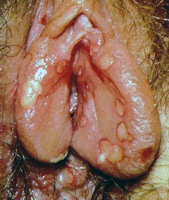 성매개감염진료지침 성기단순포진 (Genital Herpes) 병인 Herpes simplex virus (HSV) 2 형, 1 형 임상소견 임상사진 원발성 (primary)
