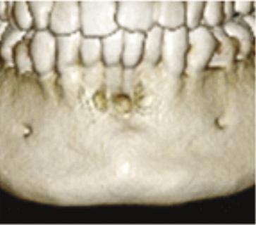 Inflammatory granulation tissue grows on the labial side of #31, #41 area, and