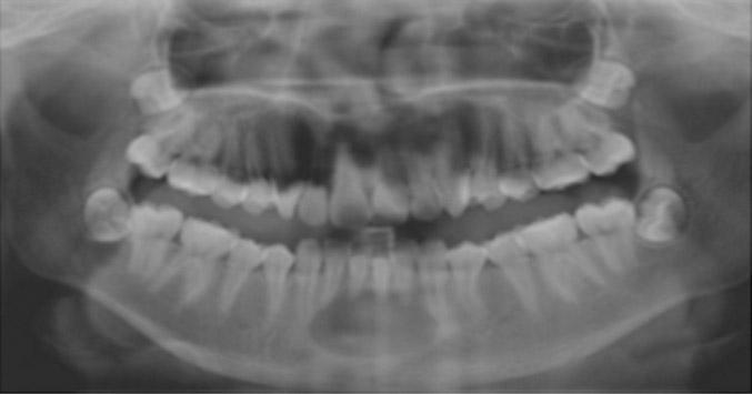 24 months after operation: Radiolucent lesion became radiopaque. Dental CT view Fig.