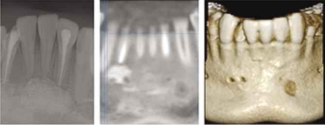 치과병력은약 5년전상악유전치를발거하는중에 #42 치아치관부의파절이발생하였다고하였으며전신적특이병력은없었다. 치아우식등의소견은보이지않았으므로외상으로인한치수의감염에의해치근낭이발생한것으로판단되었다.