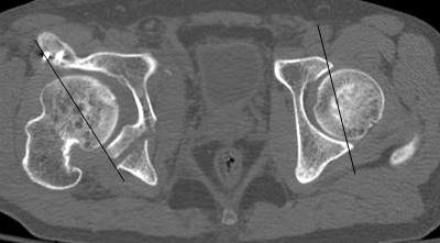(C) Postoperative radiograph shows excessive correction after periacetabular osteotomy.