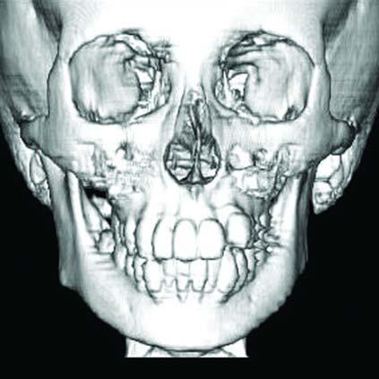 Parry-Romberg Syndrome 환자에서악정형및교정치료 Figure 3. The panoramic view at the age of 10. Figure 5. 3-dimensional computed tomography at the age of 13. Figure 4.