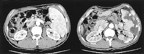 C and D show non-filling of the peripheral vessels due to obstruction of emboli material (arrows). A B Figure 2.