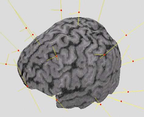 3 이후뇌파전극을부착한후뇌전산화단층촬영 (brain computed tomography) 을시행하여전극의위치를연구하기도했으며, 4 자기공명영상 (magnetic resonance imaging, MRI) 촬영이가능한장치를이용하여뇌파전극을부착한상태에서뇌 MR 영상을얻고 5 뇌파전극에상자성 (paramagnetic) 의표지자를부착하여뇌 MRI