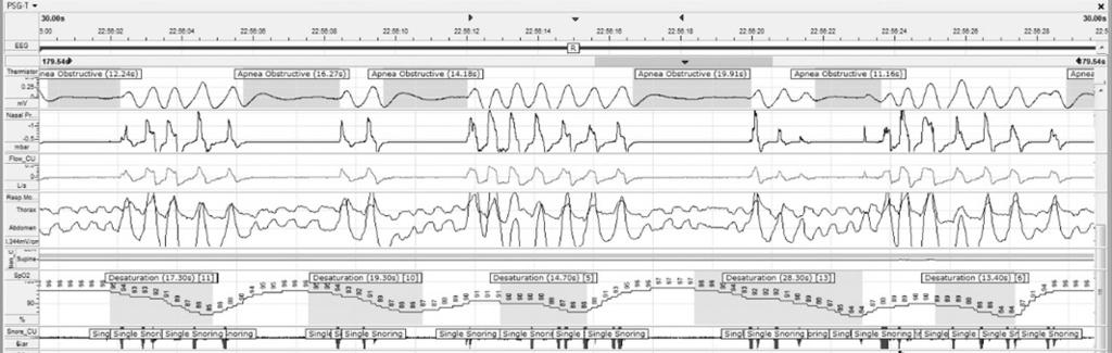 218 Ki-Bong Kim, et al. Sleep Disorder and Sleepy Drivers M1와 M2를사용하였다 (Fig. 1).