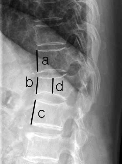 (A) Preoperative radiograph; (B) postoperative radiograph. Vertebral body height before compression fracture (Y); Y=(a+c)/2. Anterior height restoration rate (AR); AR=(e-b)/Y 100(%).