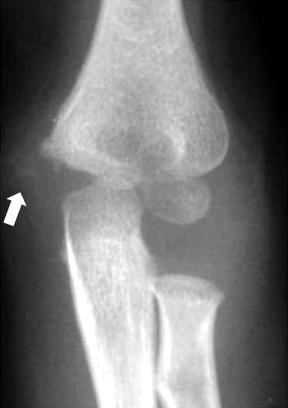 (B) However, a radiograph taken 7 days after the trauma revealed a medial condyle fracture of the distal humerus (white arrow: