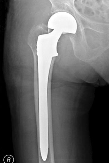 242 고덕환, 김기환, 김형준, 김동헌 Fig. 2. A 80-year-old female with right hip pain. (A) Preoperative radiograph showing a Garden stage IV basicervical femoral neck fracture.