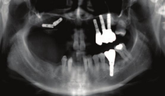 17 Fig. 2. Pre-operatative panoramic radiograph. Note that the implant fixtures moved. Fig. 4.