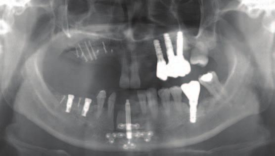 posterior area and distraction osteogenesis on mandibular anterior region. Fig. 3.