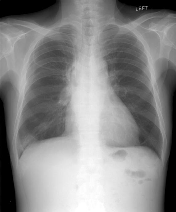 Follow-up chest film reveals improvement of pneumonic infiltration at right hilar area.