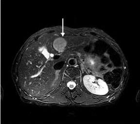 - 김지훈. 간세포암 - T2 T1 Gd 15 sec Gd 85 sec Gd 5 min Figure 2. Dynamic MRI. A mass on segment 2 is indicated by arrow.