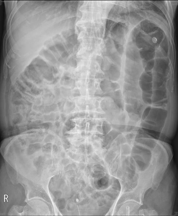 A B Figure 1. Abdominal X-ray at second day of admission. Small and large bowels were distended diffusely without evidence of obstruction (A).