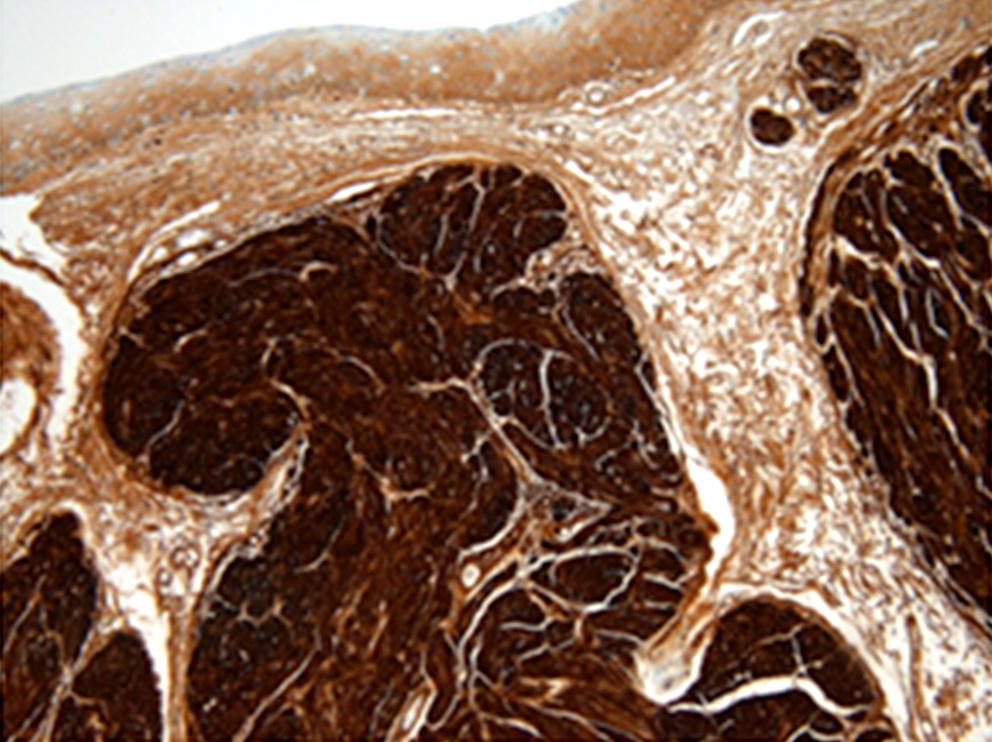 () Immunohistochemical staining reveals diffuse expression of S100 ( 100). Figure 4. bdomino-pelvic CT shows 1.