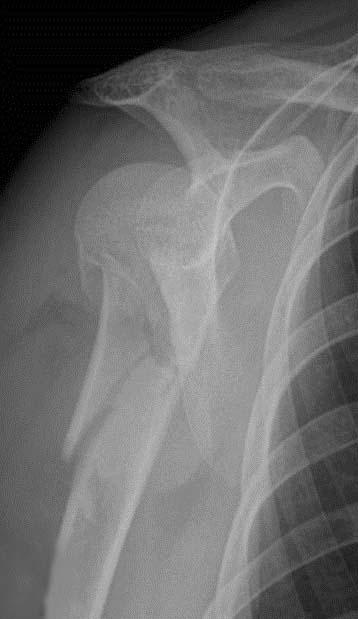 Initial radiographs of a 26-year-old woman shows proximal humerus