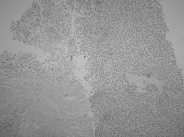Park DS A Lymphocytic infiltration Tumor necrosis B Figure 3.