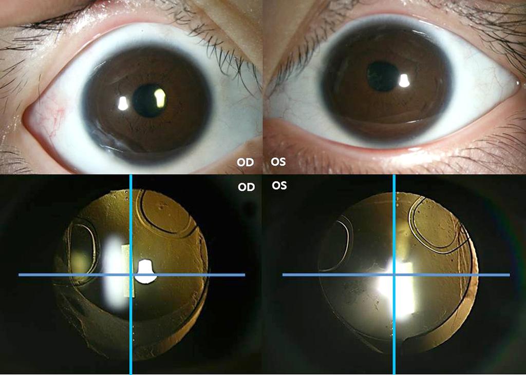 - 박대현 정진권 : 선천성수정체부분이탈환자의수술방법 - A B C Figure 3. Postoperative photohgraphs. (A, B) External photographs shows clear cornea, conjunctiva and round pupil 3 months after operation.