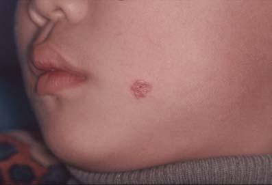 6 cm-sized, well-defined, scaly erythematous plaque on the left cheek.