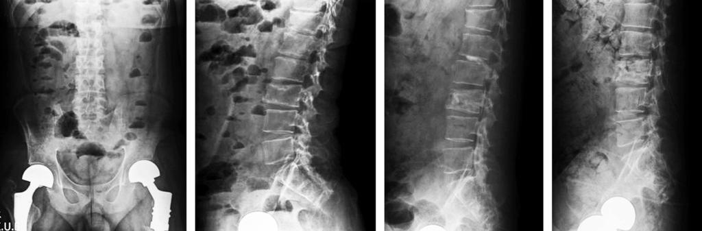S1. Her last follow-up anteroposterior (C) and lateral (D) radiographs 8 years later show some bone subsidence. A B C D Fig. 2.