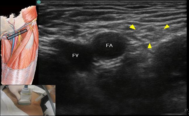 femoral artery, paresthesia or nerve stimulation Ultrasound guided block technique: Transverse section of superior thigh.