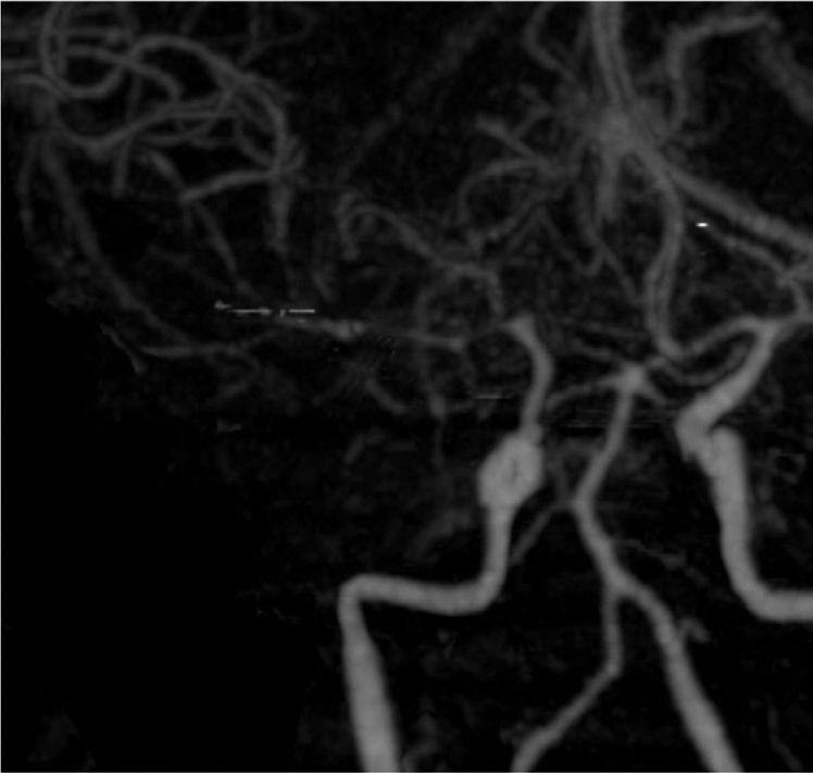 -DSA = digital subtraction angiography, S-CTA = standard CT angiography A B C Fig. 1.