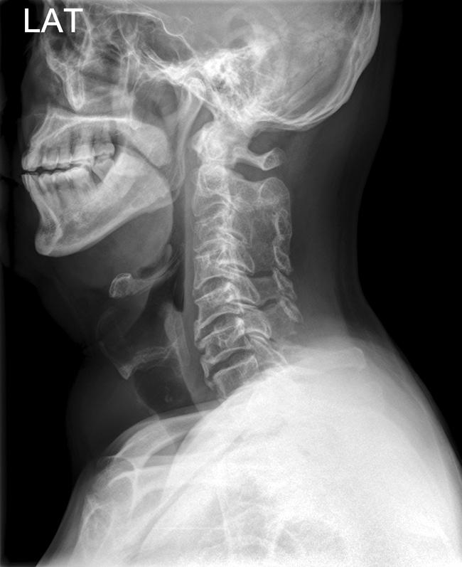 377 경추후궁확장성형술의합병증 Figure 2. (A) Lateral view of the cervical spine with postoperative spontaneous interlamina fusion.