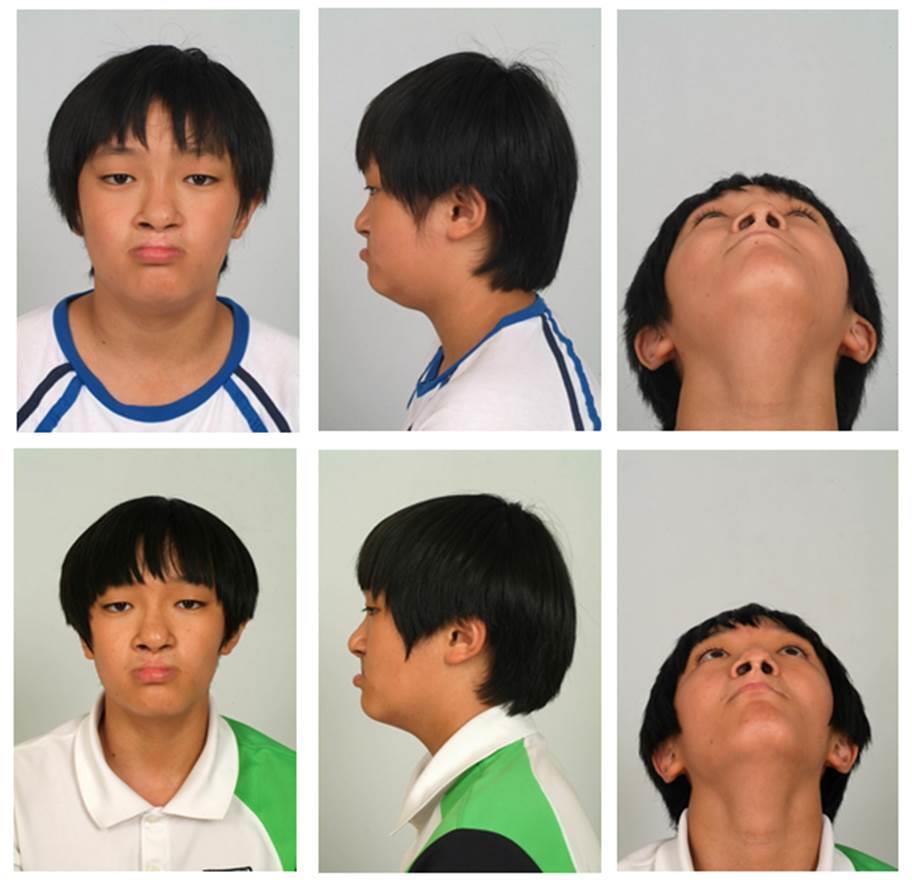 Figure 6. A male patient with secondary nasal deformity underwent corrective rhinoplasty(bardach s technique).