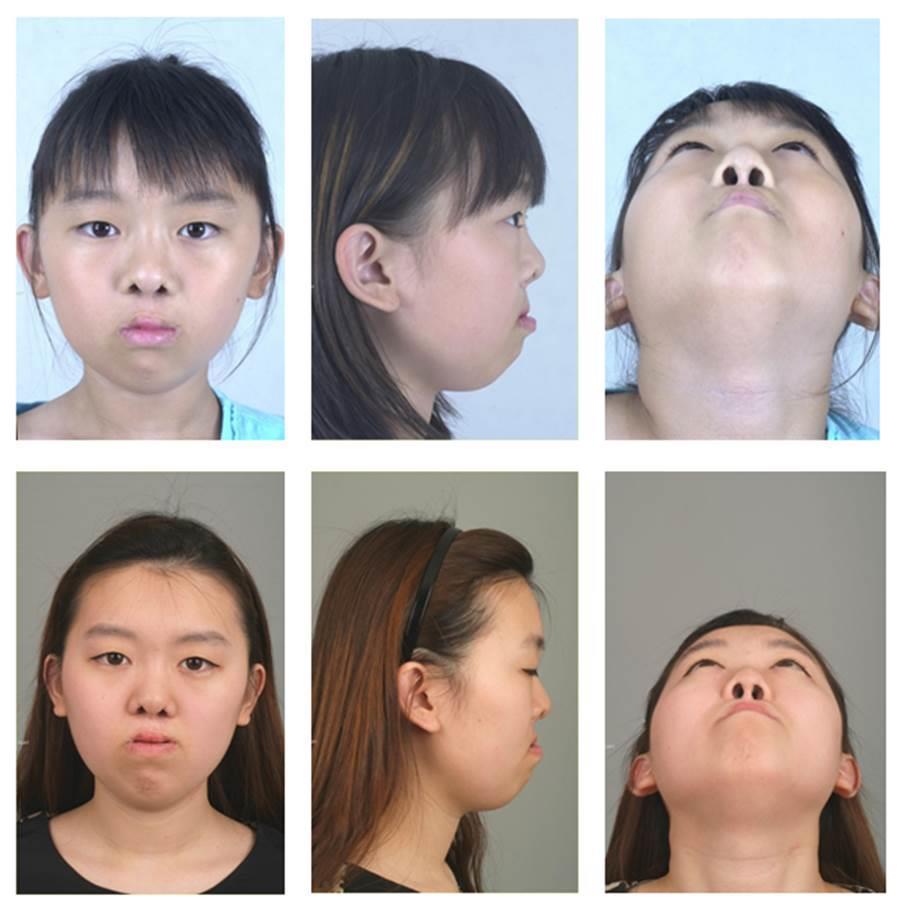 Figure. 7. A female patient with secondary nasal deformity underwent corrective rhinoplasty(bardach s technique).