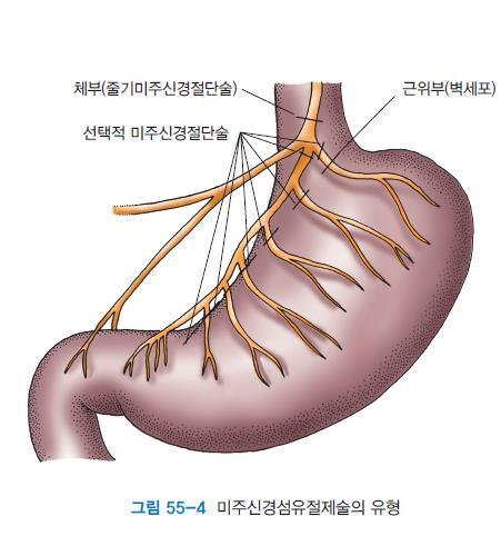 소화성궤양질환 (peptic ulcer disease; PUD) 상부위장관출혈의관리