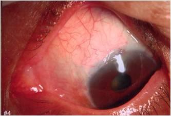 Both eyes of a 70 year-old female who was diagnosed with primary open angle glaucoma.