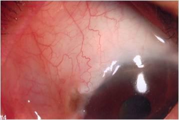 Conjunctival injection increased and was observed longer in the eye with collagen matrix