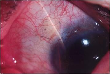 Bleb height of a 55 year-old female who was diagnosed with chronic angle closure glaucoma.
