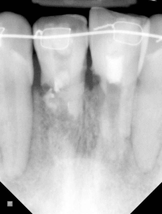 Case Report Fig. 2. Extracted right maxilla central incisor (#21), severe external root resorption extended to cementum, dentin and pulp canal can be seen. Fig. 1.