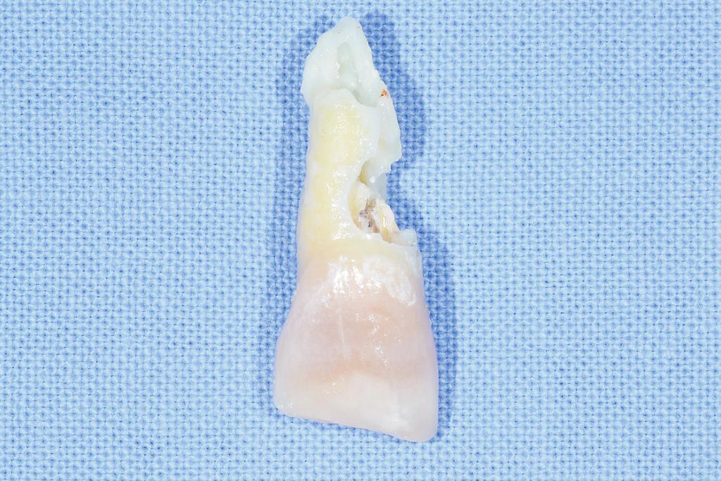 The treatment plan is extraction of central incisor and implant surgery at this site after Orthodontic treatment of adjacent teeth. 대학교 치과병원에 내원하였다. 주소 치아는 수년 전 외 상에 의한 탈락과 재식립 병력이 있었다.