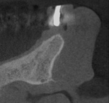 Fig. 4. Cone-beam computed tomography, cross-sectional view at the implant placement site (#21, maxilla left central incisor). Kang-Hee Lee et al.