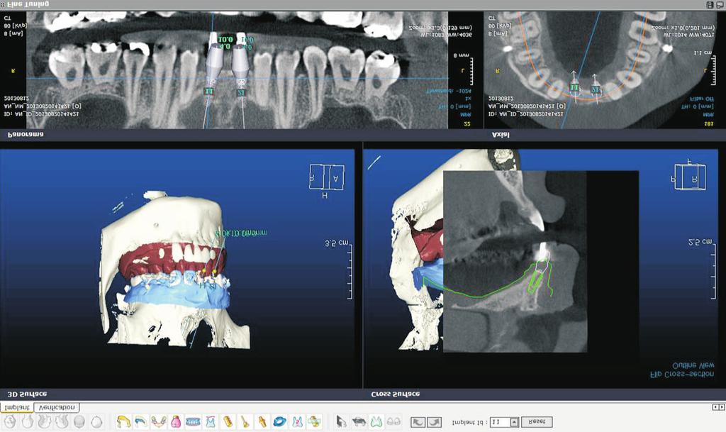 Case Report Fig. 5. Implant placement planning was done using various images, In2Guide implant planning progam (CyberMed, Seoul, Korea). 3D skull, cross-sectional view, horizontal view, etc.