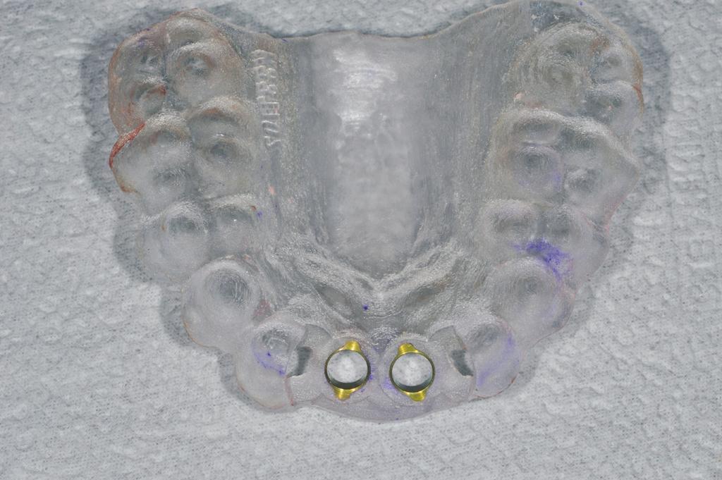 A computer guided surgical stent made of acryl using three-dimensional print. 형성을유도하였다. 치간유두의재형성을유도하기위해서치조골의높이와치은의두께를고려해임시치관의인접면접촉점을치조골 5 mm 상방에형성하였다 4,5.