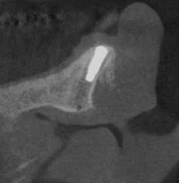 Bone graft was done at the buccal site, to compensate narrow alveolar ridge. Kang-Hee Lee et al.