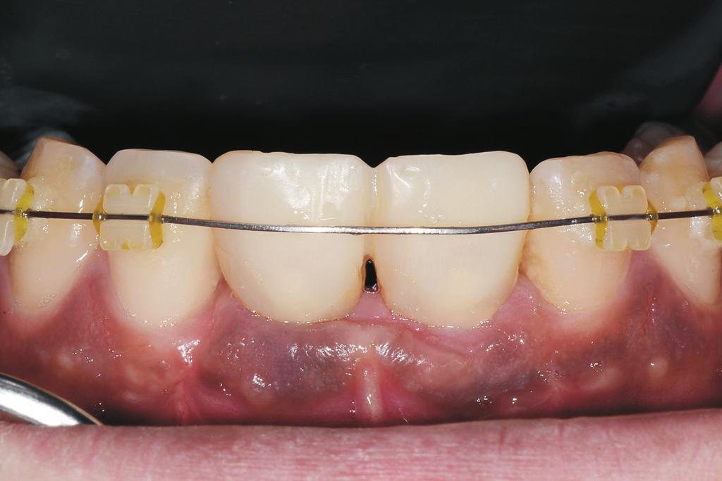 Clinical photo with installation of abutment and resin temporary crown after second surgery.
