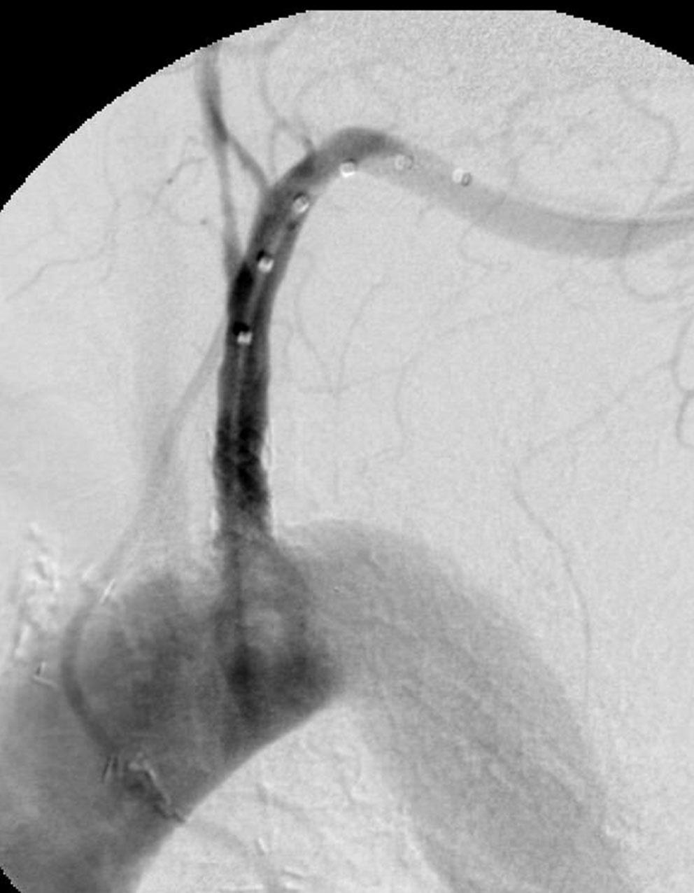 . rteriogram shows in-stent stenosis in the proximal left subclavian artery (arrow).