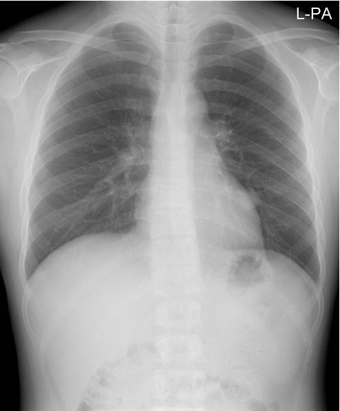 대한내분비학회지 : 제 23 권제 6 호 2008 C Fig. 2. Simple chest X-ray findings of the patient shows about 2.
