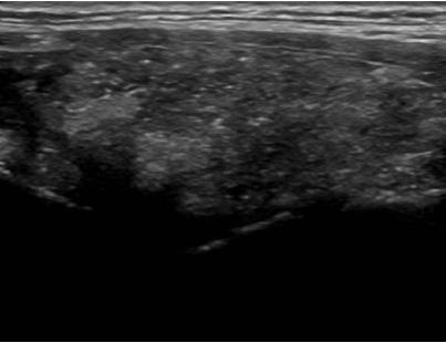 Ultrasonographic finding of neck shows heterogenous parenchymal echo with ill-defined hyper- and